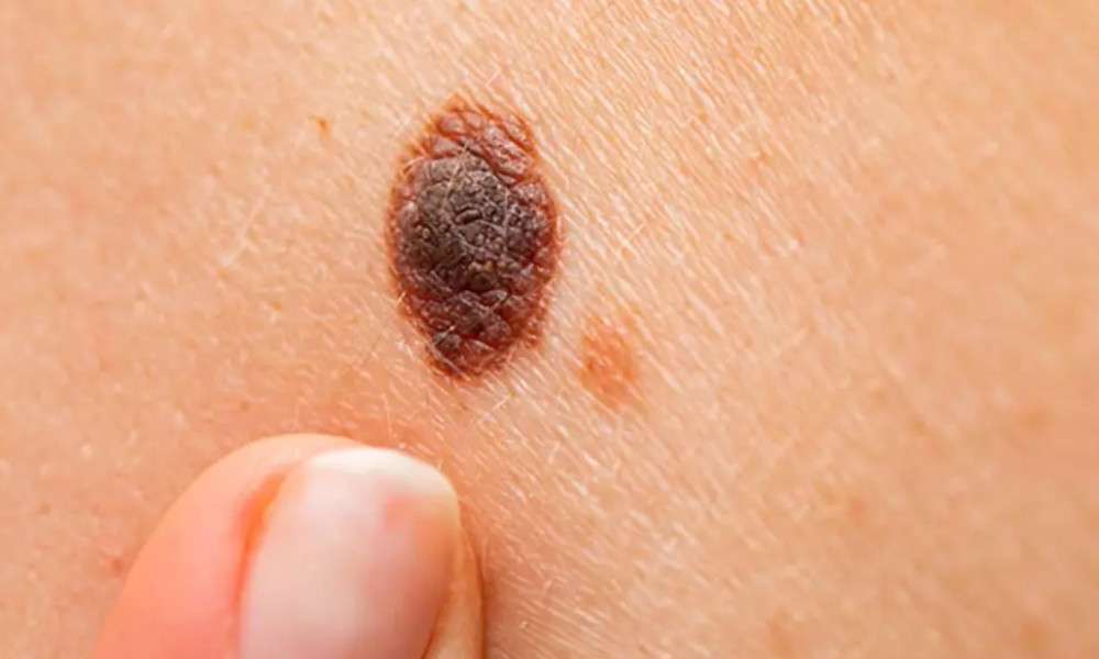 İyileşmeyen yaralar deri kanseri belirtisi olabilir   