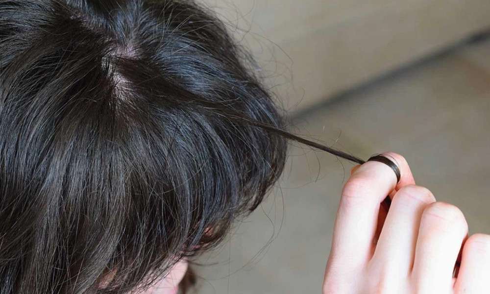 Toplumun y&uuml;zde 1'i Trikotillomani hastası 