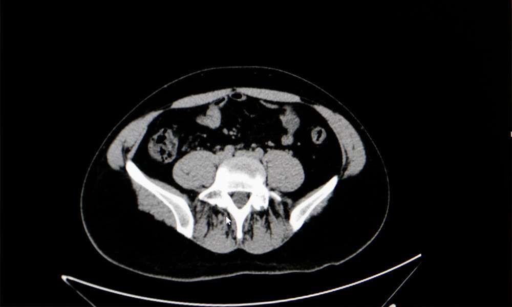 Uzmanından yaz aylarında çok görülen sistit uyarısı   