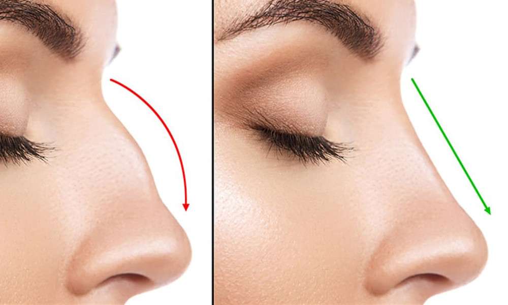 Yabancılar burun estetiği i&ccedil;in T&uuml;rkiye'yi tercih ediyor   